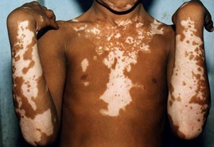 Obat Vitiligo Yang Ampuh
